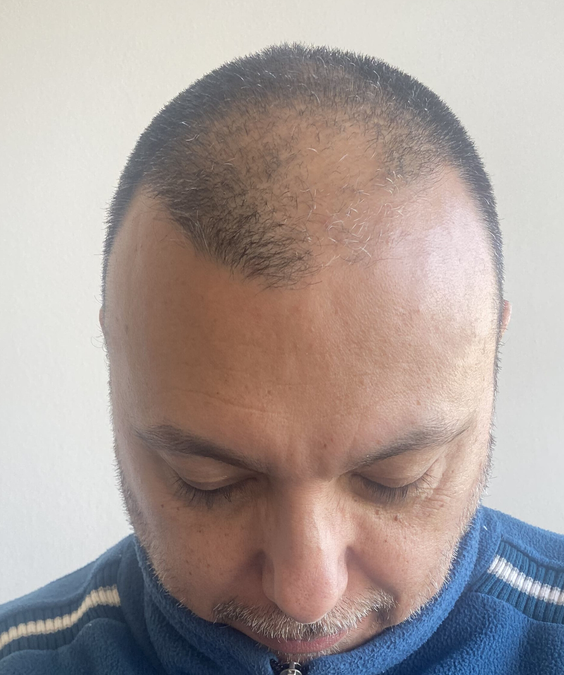 Antes Efecto Densidad