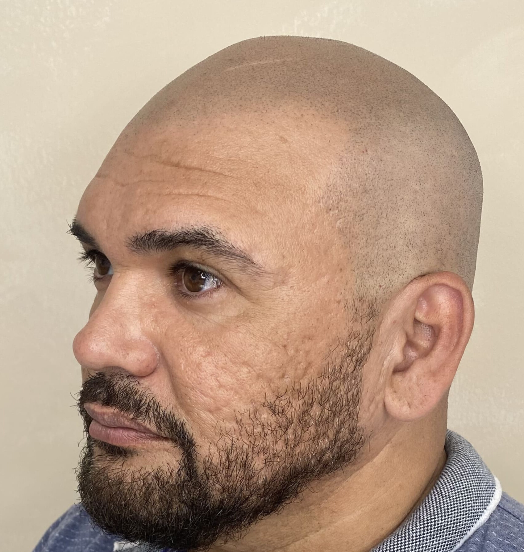 Después Efecto Rapado