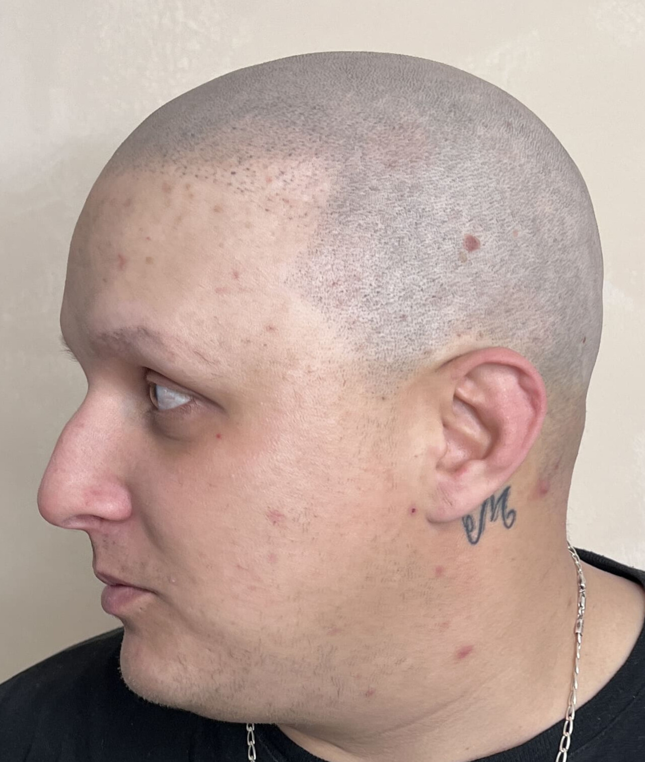 Después Alopecia Areata