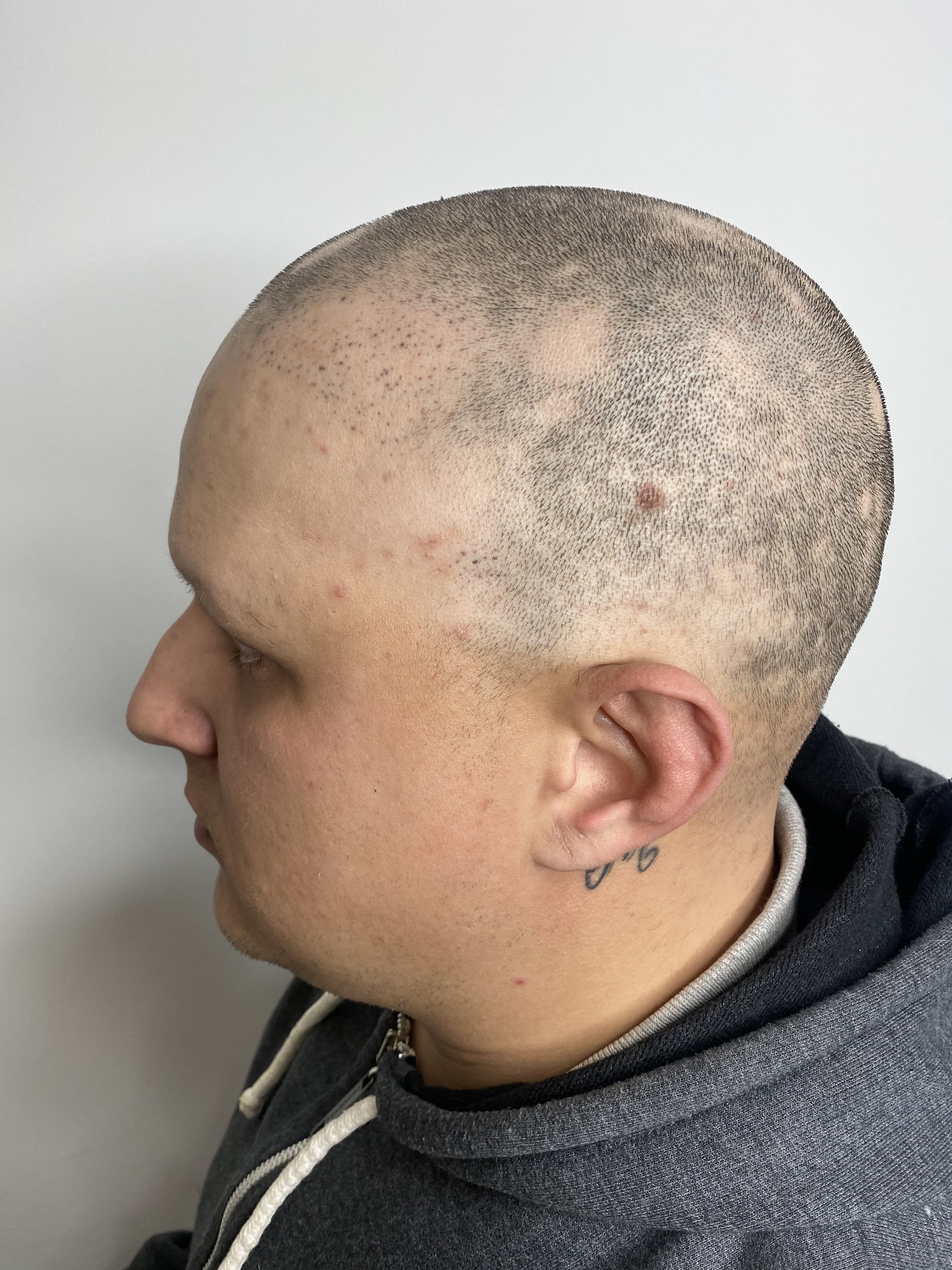 Antes Alopecia Areata